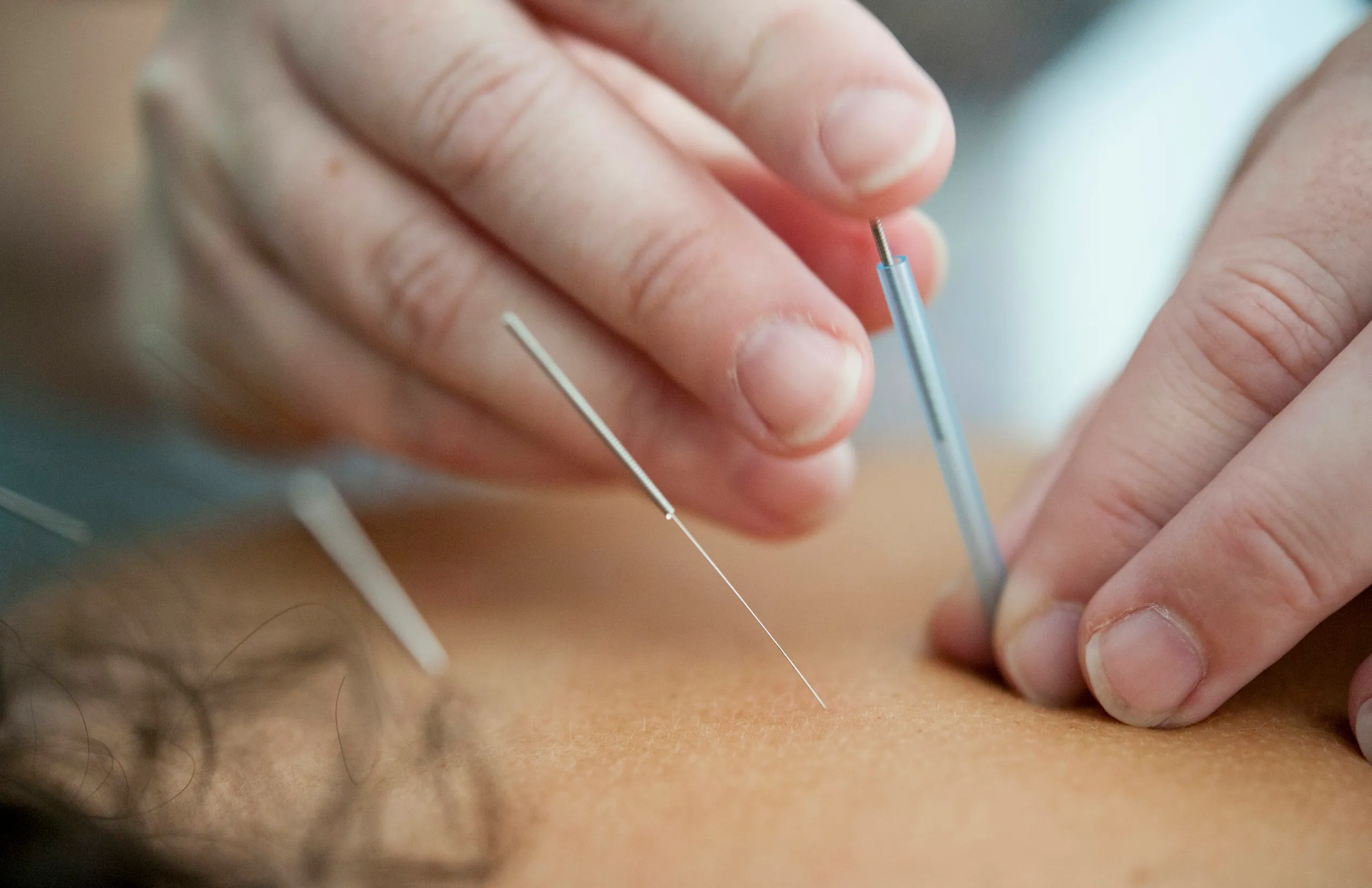 Atendimento de Acupuntura na Nishi Academy